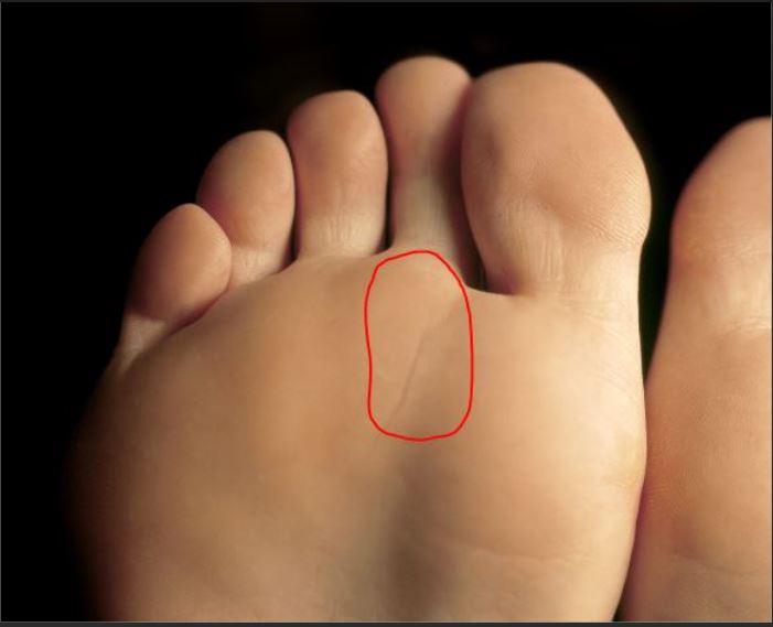 Why Does A Plantar Plate Tear Occur Walk Without Pain