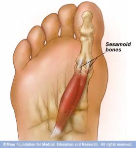 Sesamoiditis / sesamoids of the foot 