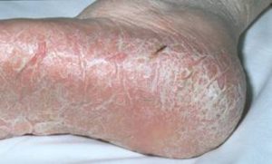 Dry, cracked tinea