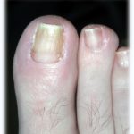 Ingrown Toenail Surgery Brisbane